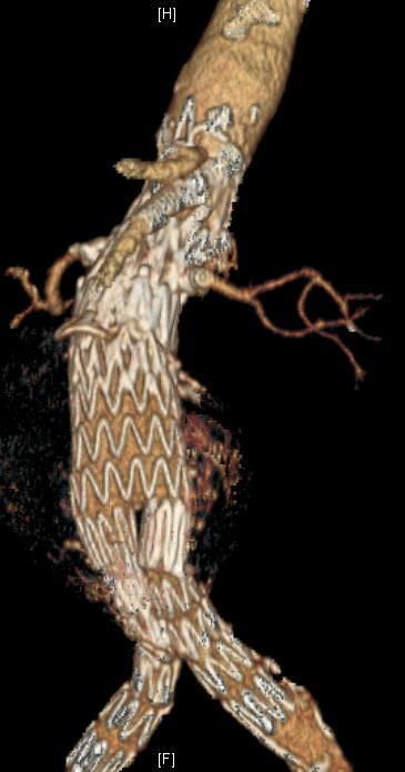 Endovascular Solutions for late EVAR Failure: Depends on etiology and stent graft