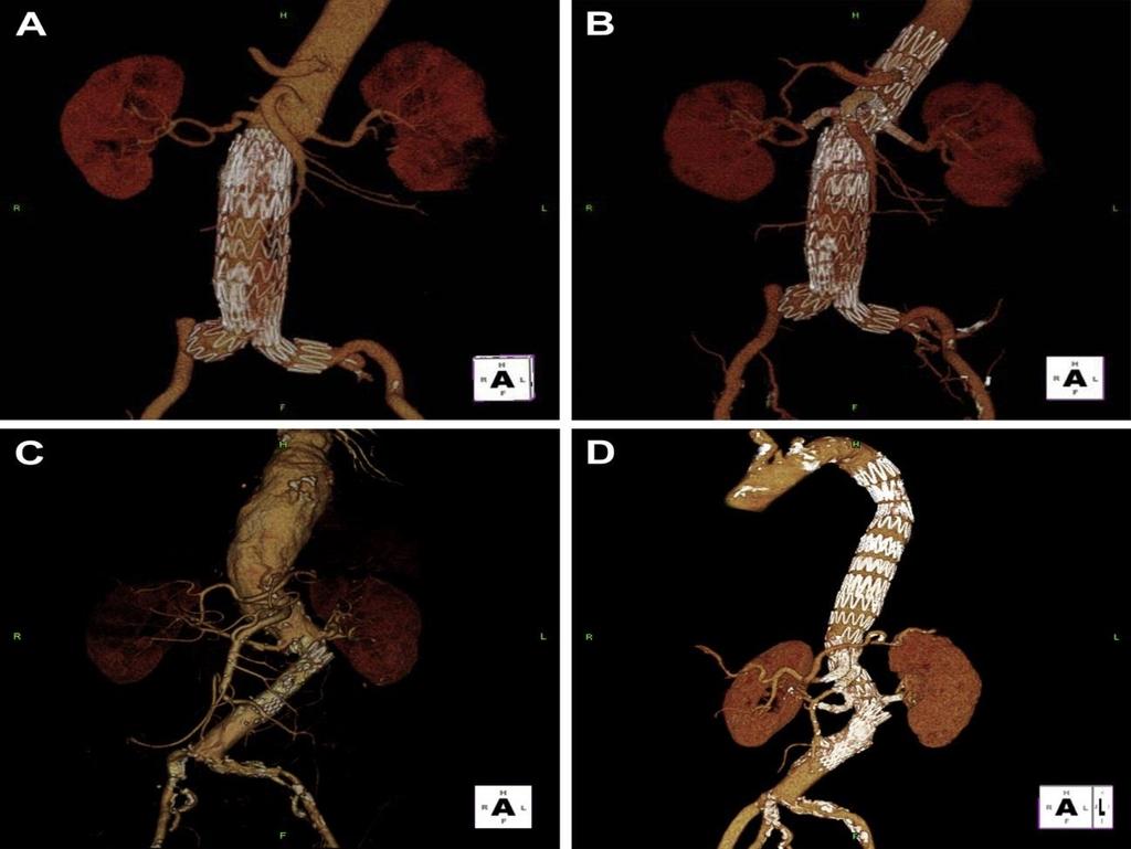 Endovascular Solutions for late EVAR Failure: Depends on etiology and stent graft design: trunk length / flow divider Fenestrated and