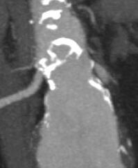 and even no neck AAAs can be treated (top stent partially crossing renal