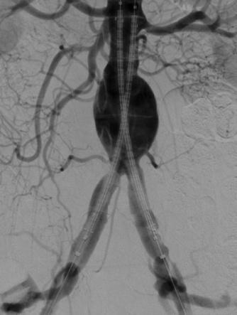 Nellix Endovascular System Aneurysm sac and proximal and distal