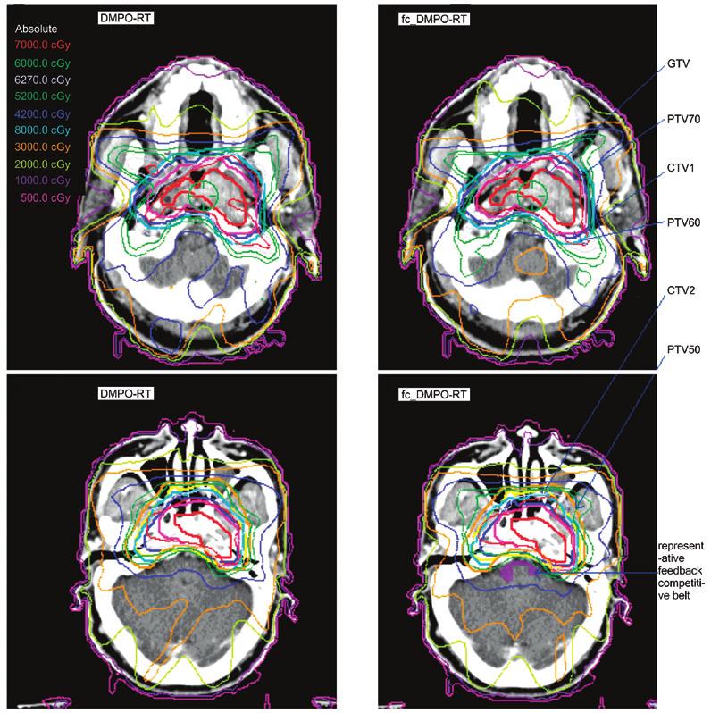 2046 LI et al: FEEDBACK CONSTRAINT OPTIMIZATION OF IMRT FOR NASOPHARYNGEAL CARCINOMA A B C D Figure 1. Axial computed tomography images comparing representative isodoses between two planes.