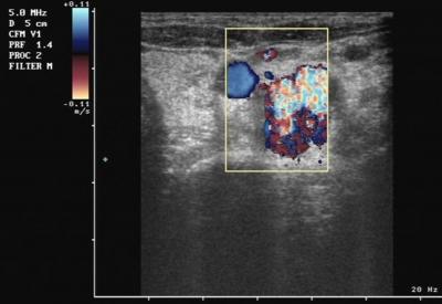 Figure 2 Figure 4 Fig.2 Vertebral AVM. Color Doppler ultrasound image shows high grade vascularity in the above mentioned cystic spaces in the neck. Fig. 4 Vertebral AVM.