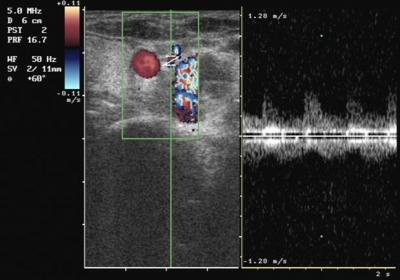 3 Vertebral AVM. Color doppler ultrasound shows High grade velocity, low resistance, monophasic spectrum in the vascular structures. Fig. 5 Vertebral AVM.