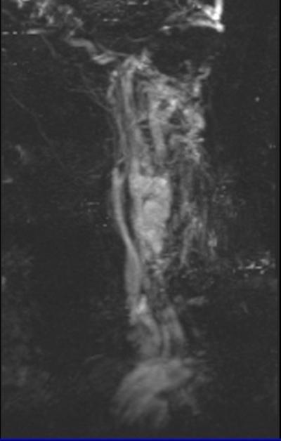 Figure 15 Figure 16 Fig. 15 Maximum intensity projection image of Contrast MR Angiography T2 FLASH 3D Coronal [TE-9.