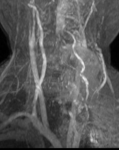 16 - Maximum intensity projection image of Contrast MR Angiography TOF [TE-7, TR-30] shows the dilated enhancing AVM in the neck along the course of vertebral artery FINDINGS Ultrasound and Colour