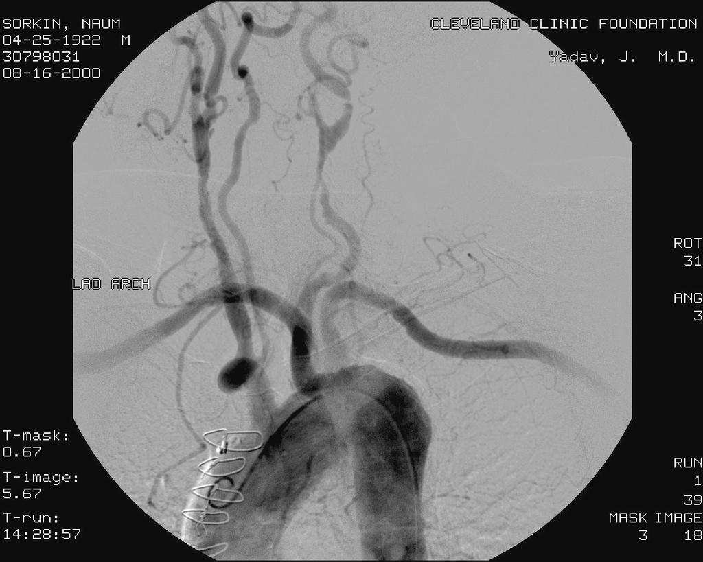 Anomalous Origin of the Right Subclavian from the Left Side of the Aortic Arch Radiation