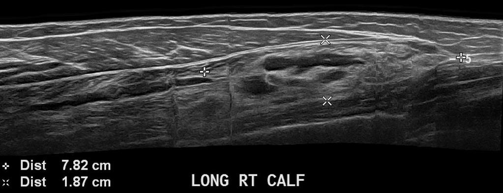 Fibro-adipose vascular anomaly Hyperechoic mass replacing normal fibrillar