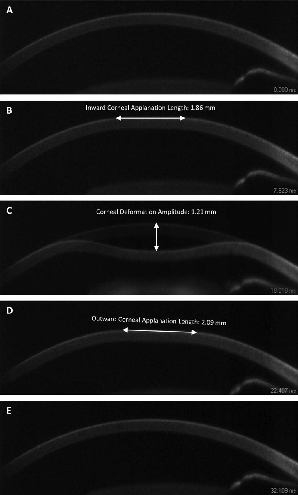 Corneal Deformation Response and IOP Measurement IOVS j April 2013 j Vol. 54 j No. 4 j 2887 FIGURE 1. Serial images of the cornea captured by an ultra-high-speed Scheimpflug camera at 0.000 ms (A), 7.