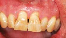 We ll explore what a mucogingival (receded gums) defect is and how to identify one, what and where to measure, and when, why and how we can treat them.