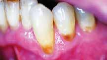 This short article will center strictly around gingival recession or areas that lack attached gingiva and possibly keratinized gingiva.