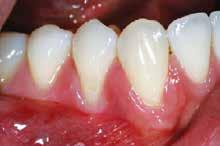 Miller s Class 1 Defect: Recession that does not extend to or beyond the mucogingival junction, with no loss of interdental bone or soft tissue.