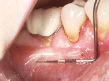 If in doubt, the first step is to identify the mucogingival junction, the demarcation of mucosa from keratinized gingiva.