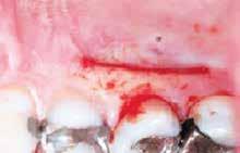 When using the patient s own tissue, we re able to harvest it intraorally, usually from the palate s autogenous gingival tissue (free gingival tissue) or autogenous connective tissue (subepithelial