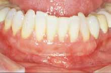The main advantages of using donor tissue is the lack of a palatal incison, which means less pain for the patient during recovery, and the ability to treat larger areas because there s not a limited