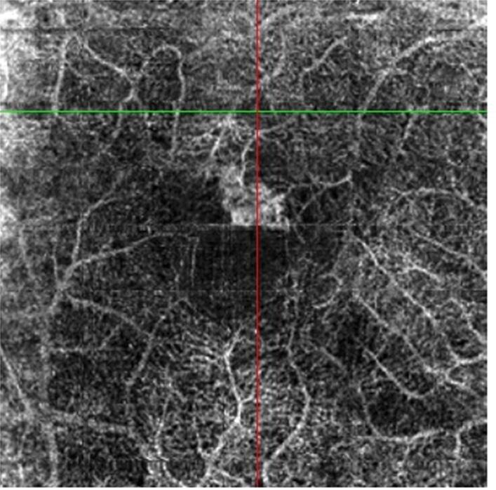 Figure 2a. Angioflow image Figure 2b. Fluorescein angiography Figures 2a/2b.