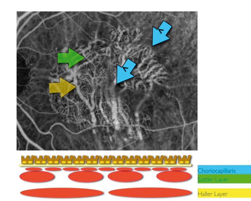 Choroidal Visualization Using a Non-Invasive Microvascular Enhanced Imaging Platform The latest stepwise improvement in imaging on the AngioVue Imaging System allows us to see aspects of the retina