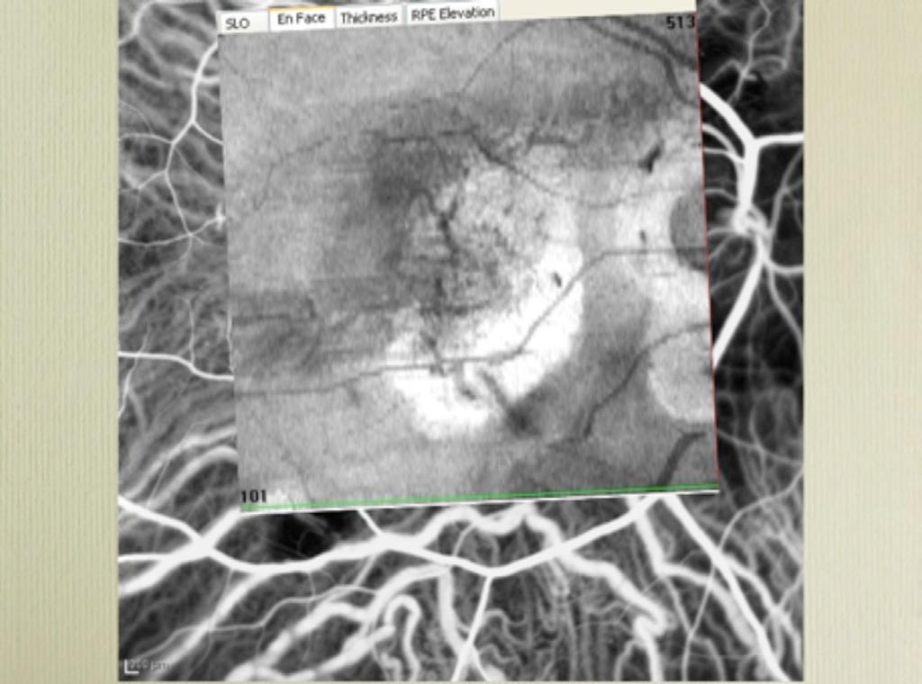 I love angiography I use both fluorescein and ICG often in my practice. I have, and will probably remain, a multimodality imaging supporter.