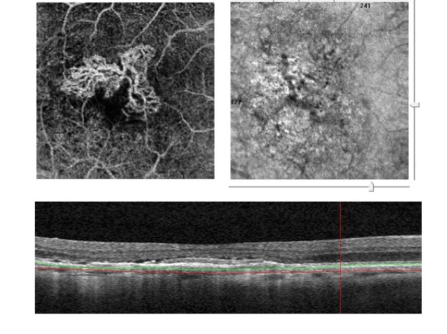quality of images, so retinal disorders such as occult lesions, polypoidal lesions, or retinal vessel changes could be seen.