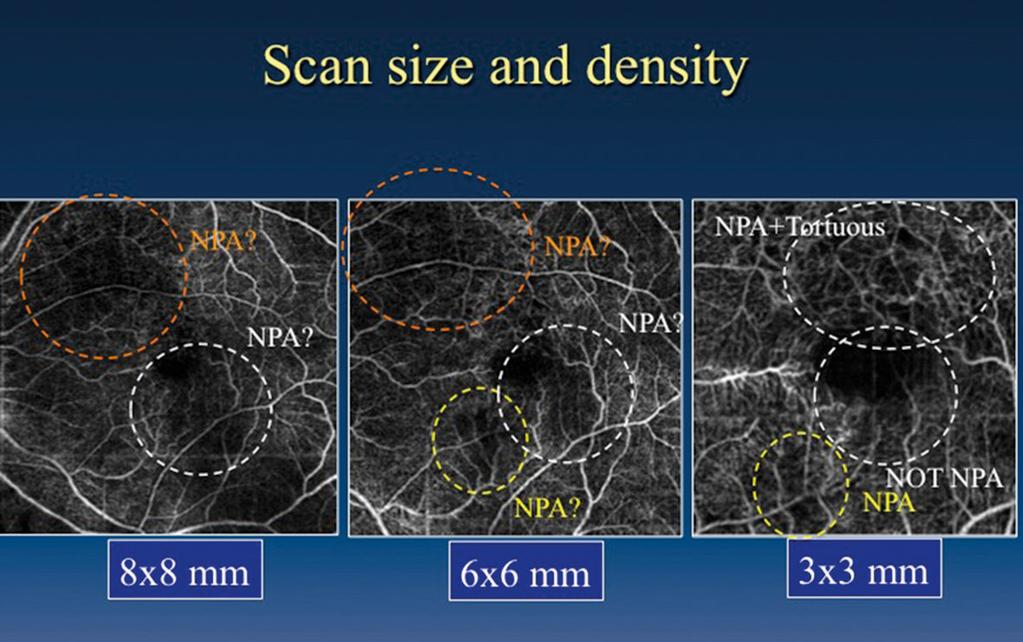 Macular Pathologies and OCT Angiography Subtleties in the vascular architecture are readily seen on the AngioVue Imaging System By Yasushi Ikuno, MD The AngioVue Imaging System is an optical