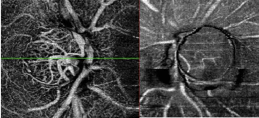 The center image shows moderate glaucoma with clear reduction of vascularization around the disc but only on the temporal inferior quadrant.