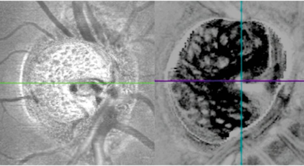 On the left with inverted contrast image, pores can be enlarged or stretched Image courtesy of M.