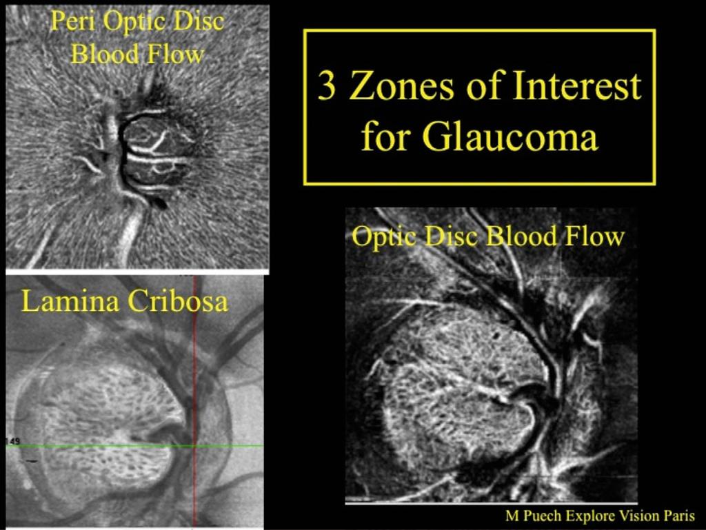 The second part of our study concentrated on analyzing the blood flow inside the disc. The AngioVue Imaging System allowed us to observe a multitude of vessels in a normal patient (no glaucoma).