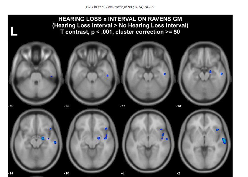 Hearing loss and subsequent brain atrophy n = 126 with