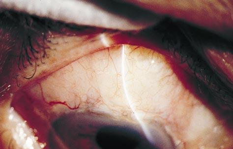 Figure 6. Appearance of a functioning filtering bleb 8 months after conjunctival advancement. This patient required aqueous suppressants due to an elevated intraocular pressure.