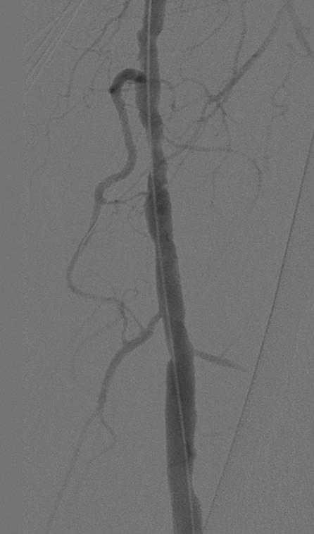 very small side branch of the popliteal artery was accidentally perforated,possiblybythedistalendofthe0.