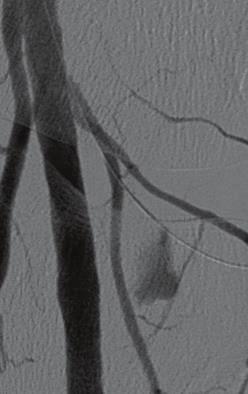 014 wire was subsequently inserted into this side branch (b), and bleeding was stopped after placement of a coronary Direct-Stent
