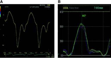 Echocardiographic tissue Doppler imaging (A and C) and