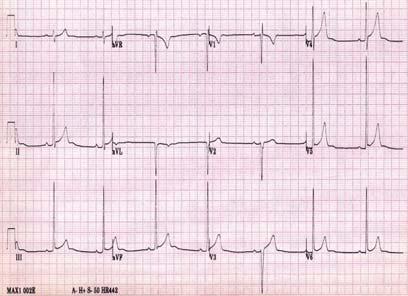 EKG Athlete s EKG Vagotonia Sinus bradycardia Sinus arrhythmia First degree AVB ST-elevation Tall T waves