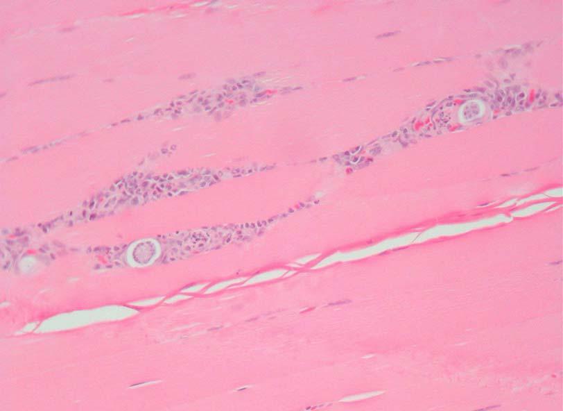 Figure 23: Skeletal muscle Multifocal muscle fibre degeneration and inflammation