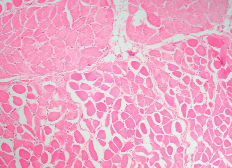 HE 200x Figure 24: Skeletal muscle (glossal) Mild muscle fibre atrophy with