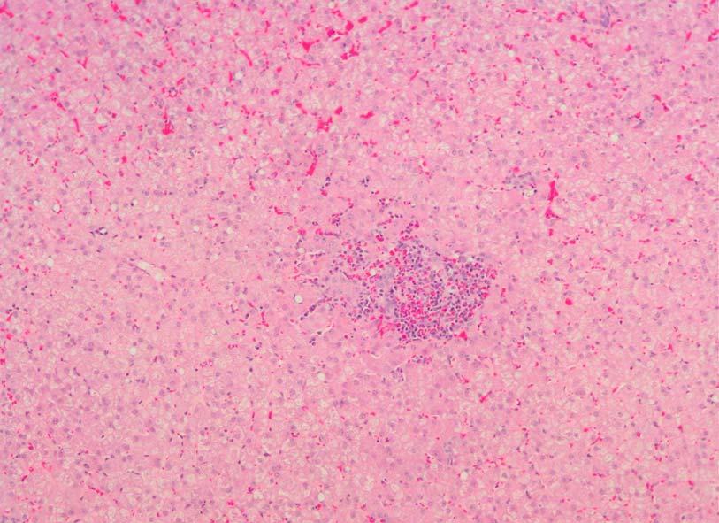 Figure 25: Liver Focal granulomatous inflammation, comprizing