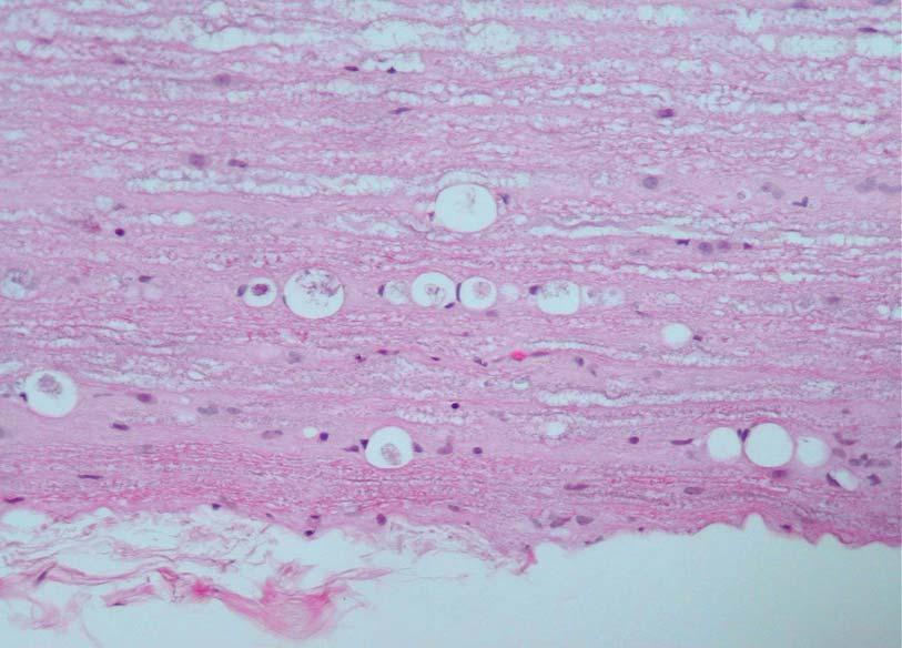 HE 100x Figure 26: Spinal cord Wallerian degeneration, with multifocal