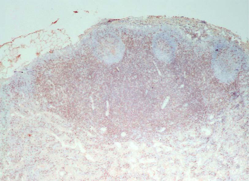 Figure 29: Lymph node Immunohistochemical staining of a frozen section for T lymphocytes.