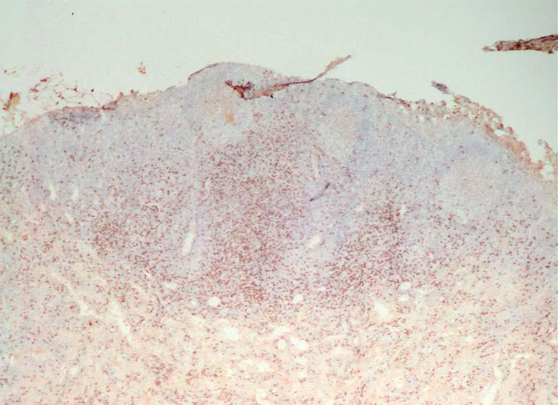 Figure 31: Lymph node Immunohistochemical staining of a frozen section for CD8 T lymphocytes.