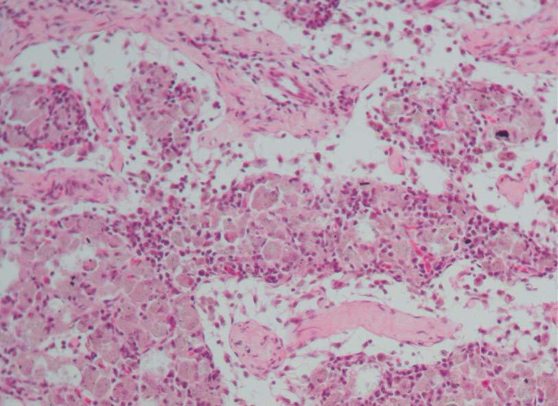 There is also intracytoplasmic haemosiderin accumulation (arrow).