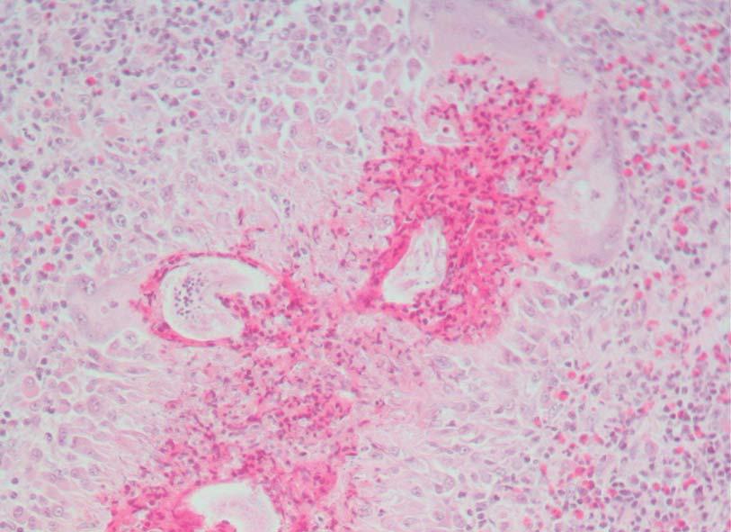 Figure 5: Lymph node Eosinophilic granuloma with multinucleate giant