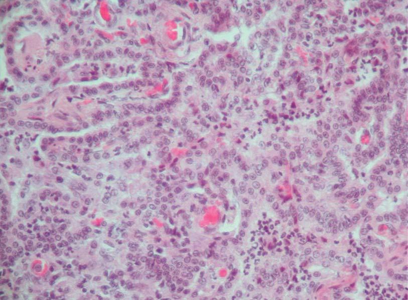 HE 40x Figure 10: Lung Chronic interstitial pneumonia with epithelialization as
