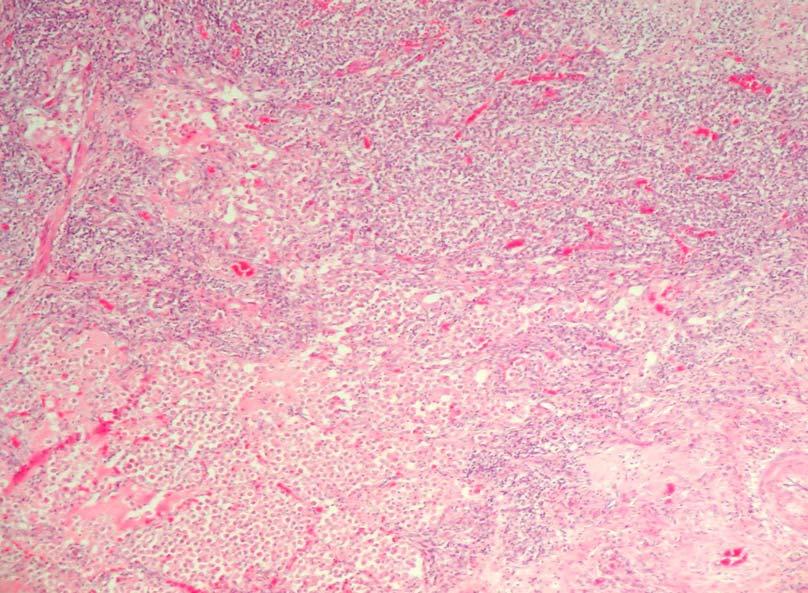 Figure 11: Lung Granulomatous pneumonia, characterized by effacement of the normal