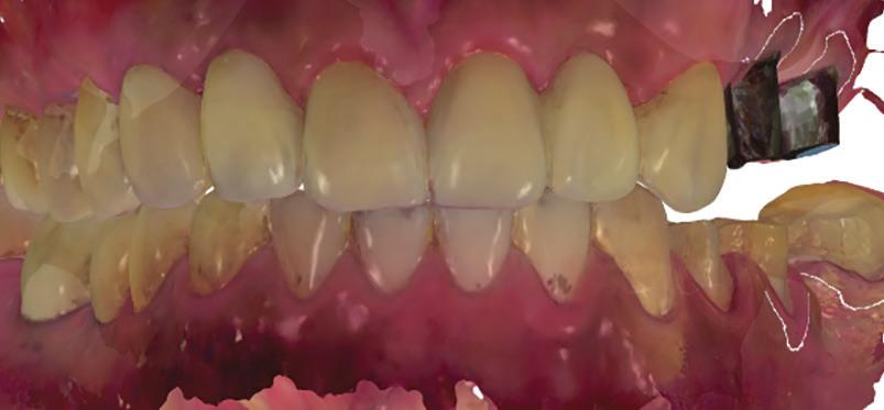 And as the provisional crowns