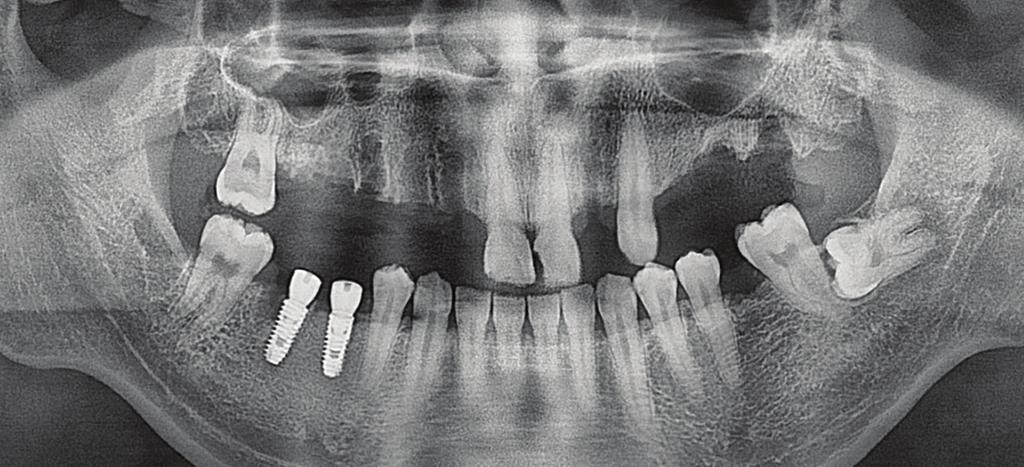 Treatment plan As the upper alveolar bone, around the root rests was damaged by the periapical lesions, immediate post-extraction implant surgery was excluded from the treatment plan for the upper