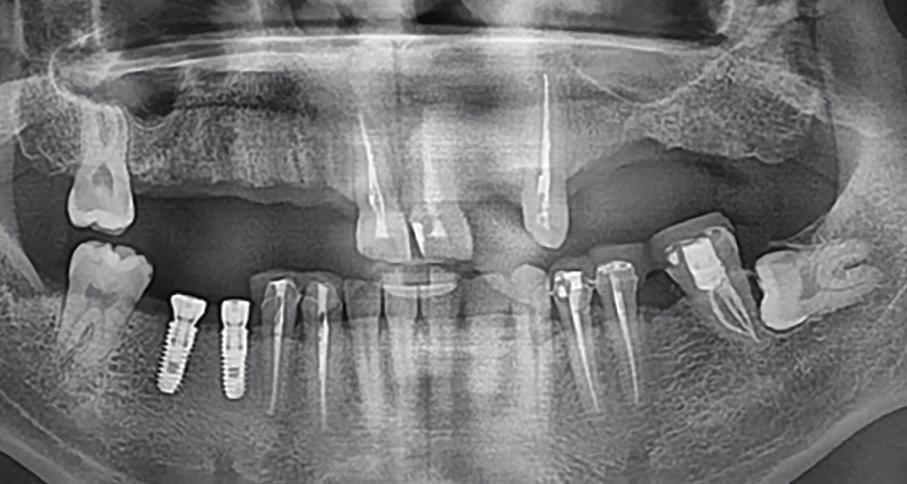 3. 2 months after the first surgery preparation on #34, #35, #37, #43, #44. Oral scan and design and fabrication of PMMA provisional crowns. Implant surgery planned with Implant Studio. 4.
