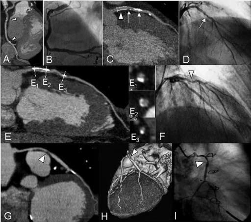 Non-Invasive Coronary Imaging and Assessment of Left Ventricular Function with 16-slice CT 57 narrowing.