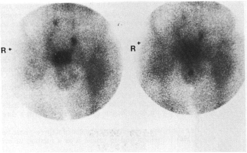 210 PARAPLEGIA R BLOOD POOL 10/26/79 FIG. I Moderate increased vascularity on dynamic flow study and blood pool. R+ BONE SCAN '10/26/79 FIG. 2 Normal bone scan.