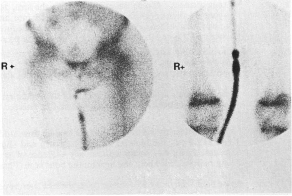 until the third study on 15 March 1979 when slight ossification was noted about the left lesser trochanter, 2 months after a positive bone scan.