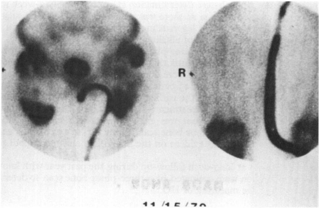 USE OF THE THREE-PHASE BONE SCAN 2Il R BONE SCAN FIG. 3 Marked increased vascularity on the blood flow study with a markedly positive bone scan. R R BONE SeA N 1/15/79 Didronel Treatment FIG.