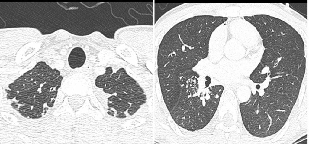 pleural area of both upper lung zones (C) and in the superior segment of right lower lobe (D). with primary pulmonary vein stenosis have some type of associated cardiac defect (6).